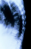 X-ray of thoracic spine showing vertebral collapse