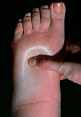Swollen foot showing pitting oedema
