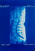 MRI scan of woman's spine in osteoporosis