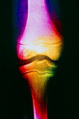 Coloured X-ray of femur affected by osteomyelitis