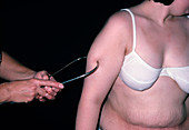 Fat measurement of obese woman with callipers