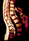 Colour MRI scan of crumbling spine in osteoporosis