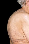 Elderly woman with osteoporosis
