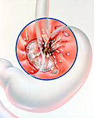 Artwork depicting oesophagitis causing ulcer