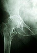 X-ray of a hip fracture due to osteoporosis