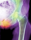 Hip fracture due to osteoporosis
