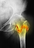 Coloured X-ray of femur fracture in osteoporosis