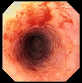 Oesophagitis