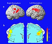 Brain response in obesity,PET scans