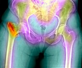 Fractured osteoporotic hip,X-ray