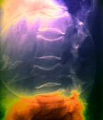 Osteoporosis of the spine,X-ray