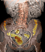 Spinal osteoporosis,X-ray