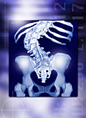 Osteoporosis of the spine,CT scan