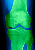 Bone death,X-ray