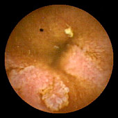 Oedema of intestinal villi,pill camera