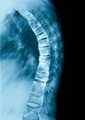 Osteoporosis of the back,X-ray
