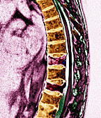 Osteoporosis,MRI scan
