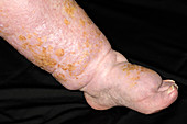 Oedema and cellulitis