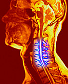 Osteochondrosis of the neck bones