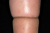 Leg oedema