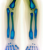 Osteopetrosis,X-ray