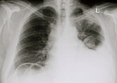 Chest X-ray showing pleural effusion