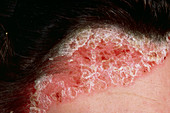 Psoriasis skin condition