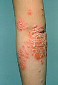 Scaly,red psoriasis rash on young woman's elbow