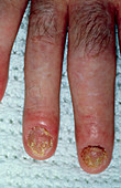 Psoriasis on man's fingers