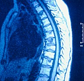 MRI scan of thoracic spine in Paget's disease