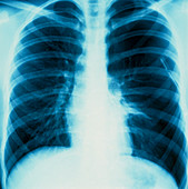 X-ray showing a lung affected by pneumothorax