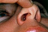 View of nasal polyp in an adult