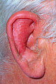 Inflamed ear of elderly man with perichondritis