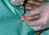 Incision of finger's tip affected by paronychia