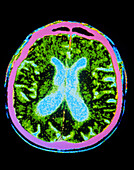 Coloured CT scan of a brain in Parkinson's disease