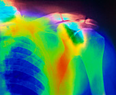 X-ray of a fractured clavicle in Paget's disease