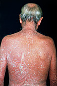 Psoriasis on the back of a 63 year old man