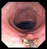 Polyp removal