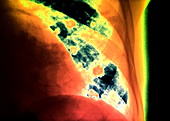 Porocephaliasis lung infection,X-ray