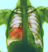 Pneumonia,X-ray