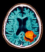 Brain lesion,MRI scan