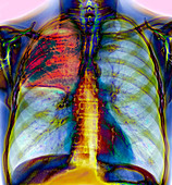 Pneumonia,X-ray