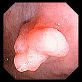 Colonic polyp