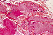 Pilomatrixoma tumour,light micrograph