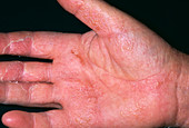 Skin rash