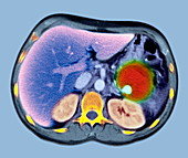 Pancreatitis,CT scan