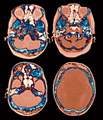Paget's disease,CT scan