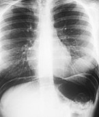 Abdominal air pockets,X-ray