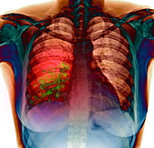 Pneumonia,X-ray