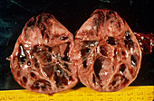 Adrenal gland tumour